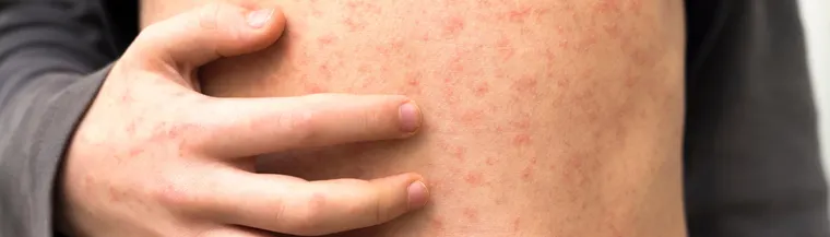 measles-rash-cdf016